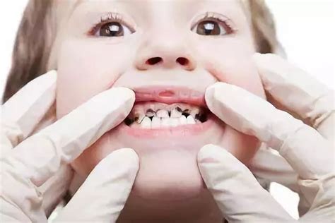 牙齿矫正的最佳时间是什么时候 三个年龄段矫正牙齿最佳_探秘志