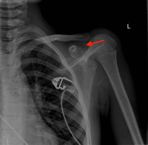 What Causes Vacuum Disc Phenomenon at Michael Dittmer blog