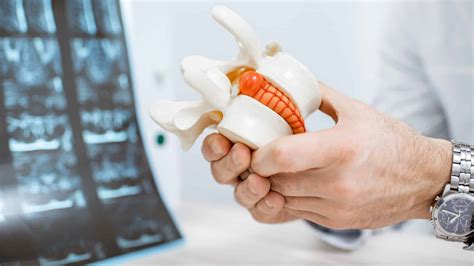 Treatment For Hnp