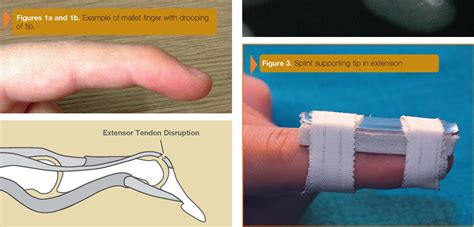 Mallet Finger Exercises Nhs at Irene Defilippo blog