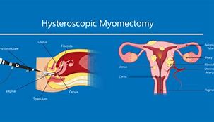 Image result for hysteroscopy