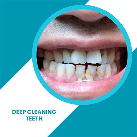Deep Cleaning Teeth - ToothFeed