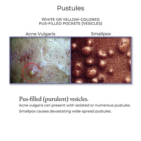 Pustules In Urine