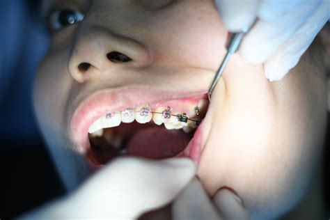 Can Braces Cause Gum Recession? - D. Dental
