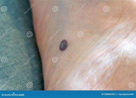 Plantar Wart Close Up On The Bottom Of A Female Foot Heel Caused By The Human Papillomavirus, Or ...