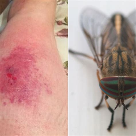 Horse Fly Bite Infection