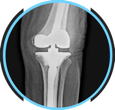 Knee Specialist And Orthopaedic Surgeon in Andheri