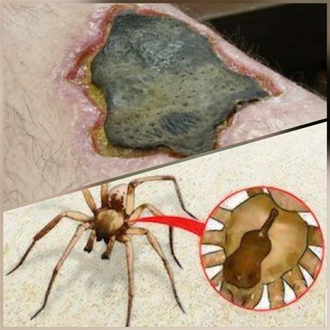 Efectos Secundarios De La Picadura De Araña Reclusa Parda