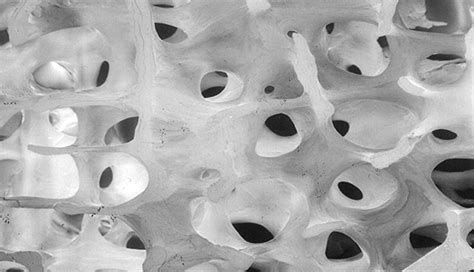 WHAT IS OSTEOPOROSIS?