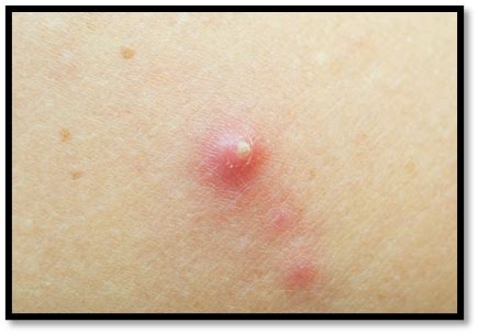 Infected Abscess Lanced 的图像结果