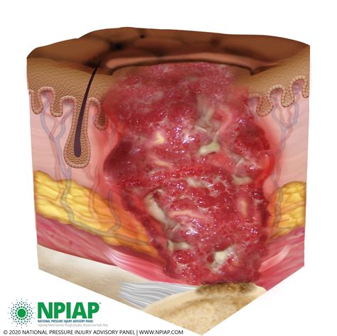 Wounds From Deep Tissue Injury Pressure