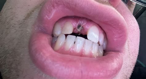 Front tooth extraction healing. hello, so I am on day 4 of healing from tooth extraction and my ...