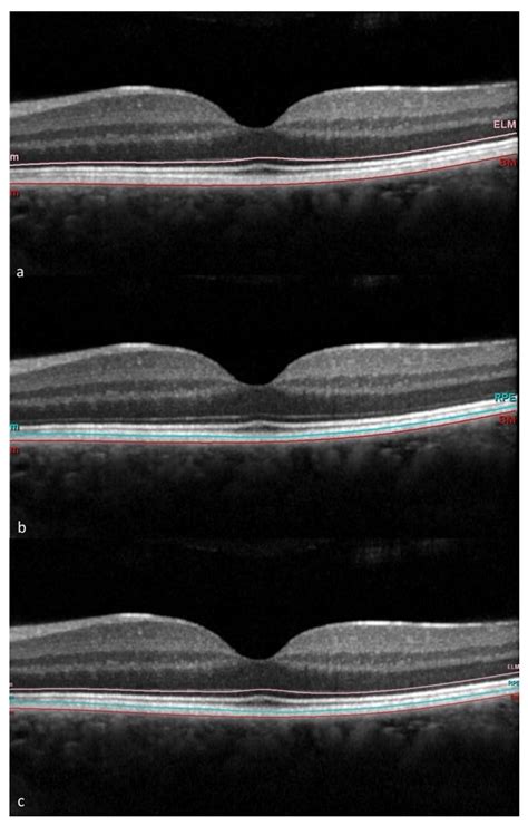 Outer Retinal and Choroidal Changes in Adolescents with Long-Lasting ...