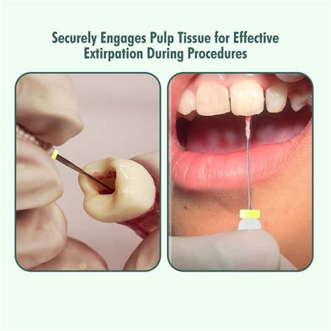 Waldent Barbed Broaches 25mm (Pack of 6) – Waldent.com