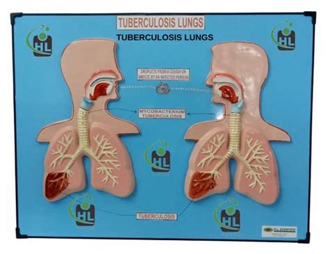 ANATOMY FORENSIC MODELS - CUSHING SYNDROME FIBER MODEL / CHARTS Trader ...