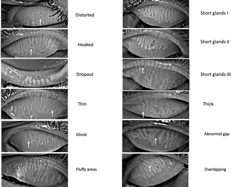 Como Emitir Nf Para Meibomian Gland Images