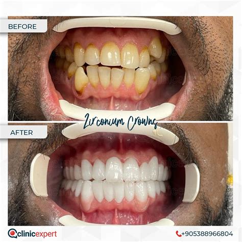 Zirconia Veneers Pros And Cons at Sean Murdoch blog