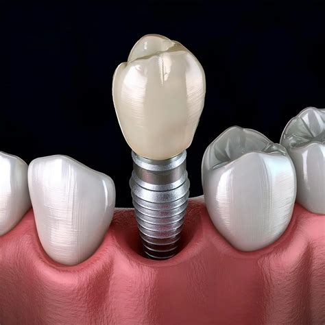 Dental Implant Step by Step Process and Timeline