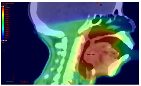 Moving beyond Definitive Therapy: Increasing Physical Activity in ...