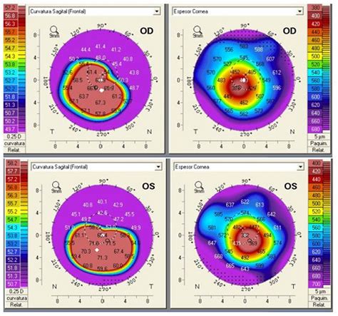 Pierre Robin sequence and keratoconus, a rare association