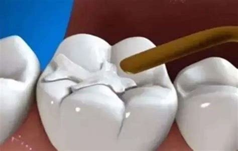 牙疼牙齿松动是因为上火吗？用什么偏方治疗-爱康健齿科