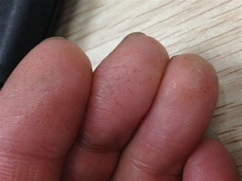 手指指尖处出现这样的水泡是什么病，不痛不痒，过几天长水泡的皮肤会变硬脱皮？有什么治疗方式？_百度知道