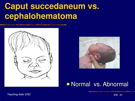 Medi Photos Illustrated Cephalohematoma Vs Caput Succ - vrogue.co