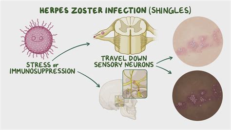 Disseminated Infection Herpes