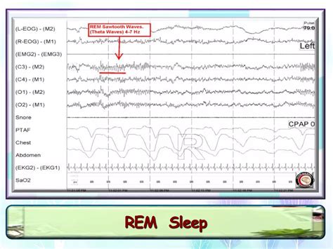 Polysomnogram interpretetion | PPTX