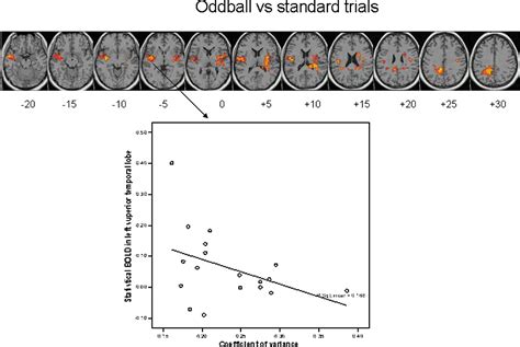 Temporal Lobe Dysfunction in Medication-Naïve Boys With Attention ...