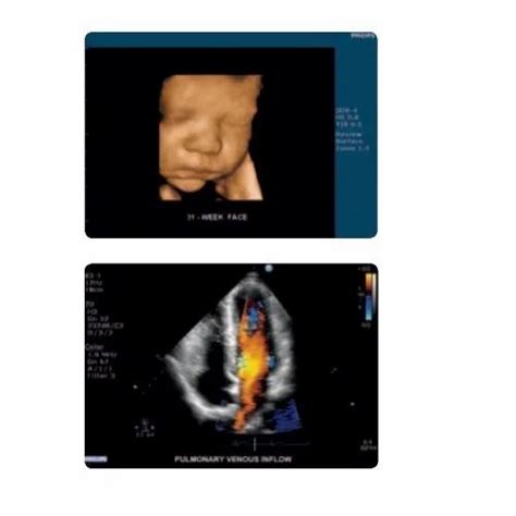 Philips Ultrasound Machine - Philips HD11XE Ultrasound Machine Trader ...