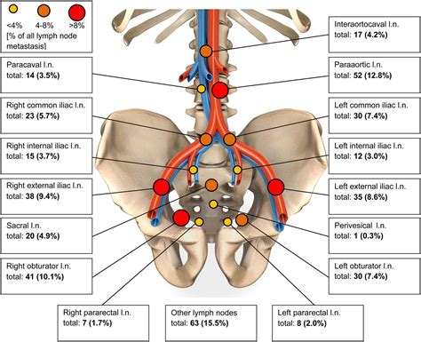 Para Aortic Lymph Nodes Treatment