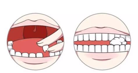 聊一聊摔跤把门牙摔断后的种牙前戴临时牙的过程 - 贝色口腔