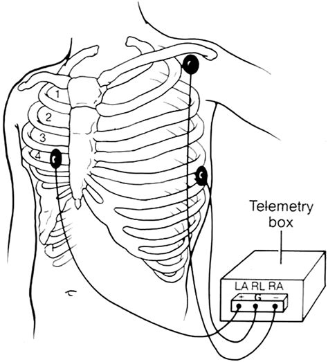 Practice Standards for Electrocardiographic Monitoring in Hospital ...