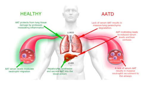 Alpha-1 antitrypsin deficiency Alpha-1 antitrypsin... | Sukhayu ...
