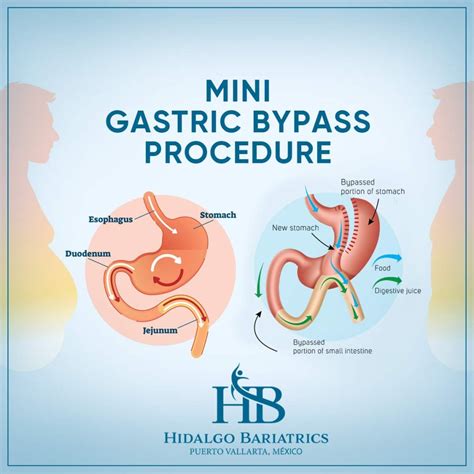 Mini Gastric Bypass: Effective Weight Loss Surgery in Puerto Vallarta