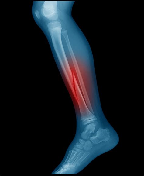 Adult Lower Leg Fracture