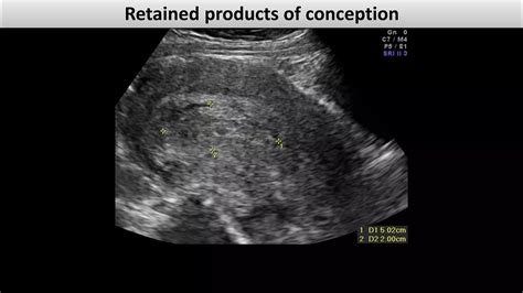 Retained products of conception dr.mohamed Soliman | PDF
