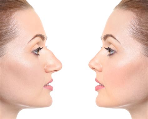 How Much Does Rhinoplasty Cost in Utah? | Barr Aesthetics