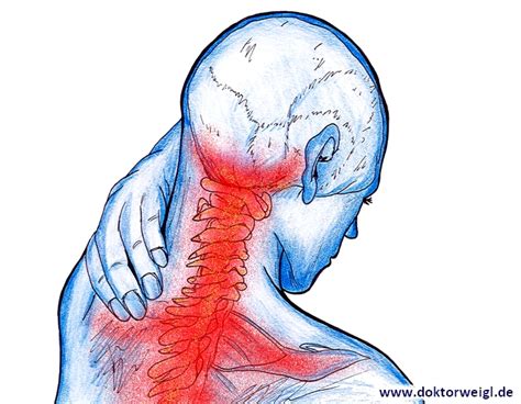 HWS-Syndrom Schwindel 的图像结果