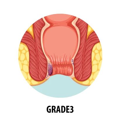 Best Piles Treatment in Delhi | | Healic Clinic