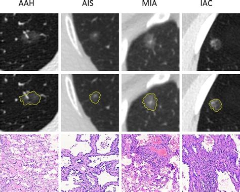 Frontiers | Evaluation of the Radiomics Method for the Prediction of Atypical Adenomatous ...