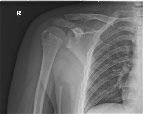 Pediatric Shoulder Dislocation X Ray at Fred Morales blog