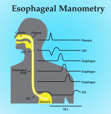 Manometry Test 的图像结果