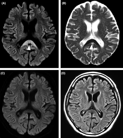 Reversible lesion in the splenium of the corpus callosum in a patient with chronic alcoholism ...