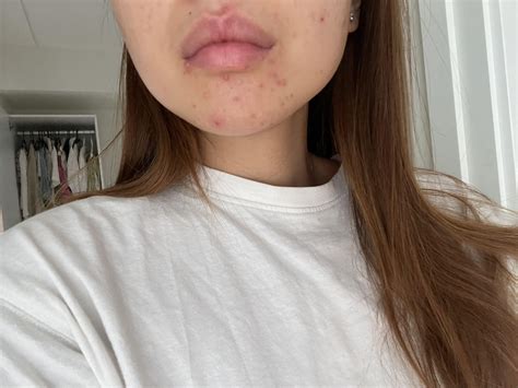 Acne around mouth keeps coming back, what to do? : r/acne