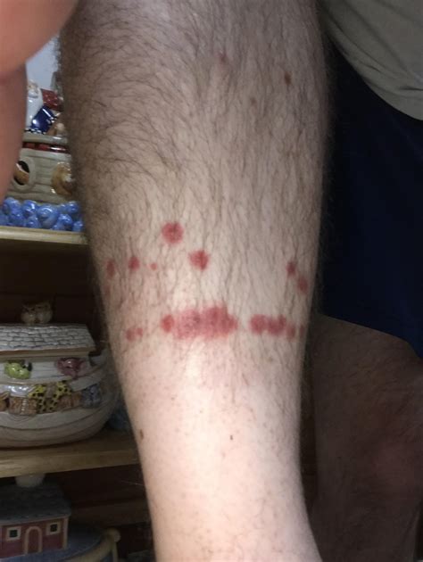 Flea Bites Allergic Reaction