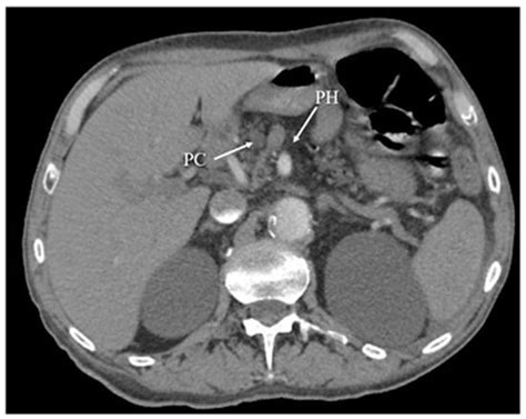 Diagnosis and Treatment of Acute Pancreatitis