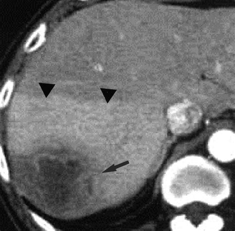 Dynamic CT of Hepatic Abscesses Significance of Transient Segmental ...