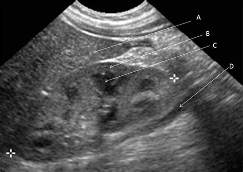 Normal Pediatric Renal Ultrasound Ultrasound Of The Paediatric
